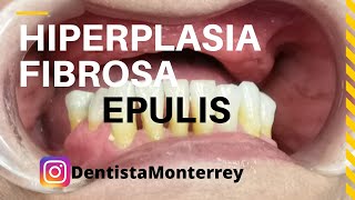 EPULIS HIPERPLASIA Fibrosa👅Causada por Prótesis Dentales [upl. by Akire]