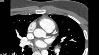 Left Circumflex Coronary Artery Anatomy on CTA [upl. by Naugal]