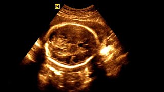 Routine antenatal ultrasound at 28 weeks gestation Ultrasonography of a 28week pregnancy [upl. by Fredrick]