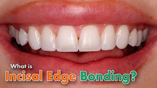 What is incisal edge bonding [upl. by Emaj150]