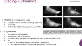 Charcot Arthropathy of Foot and Ankle By Dr Daniel Sydenham [upl. by Yrellam]