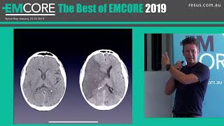 endovascular treatment of actute ischaemic stroke Dr Hal Rice [upl. by Nibas]