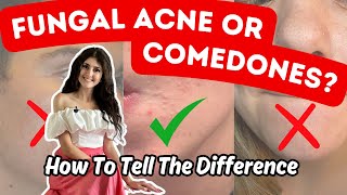 Fungal Acne VS Closed Comedones  Top 5  1 Practical Differences [upl. by Ruder942]