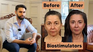 Biostimulators Work Wonders for the Face and Body Transformation [upl. by Ynohtnaleahcim]