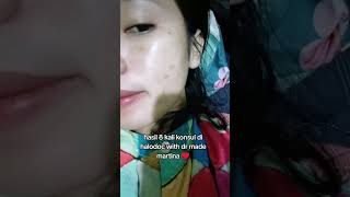 purging pemakaian salep evalen acne skincareroutine [upl. by Seibold798]