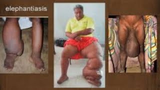 Comment soigner naturellement l’ELEPHANTIASIS [upl. by Etteniotnna]