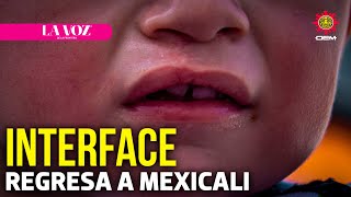 Regresa Interface a Mexicali brindando cirugías a niños con labio leporino  La Voz de la Frontera [upl. by Salbu]