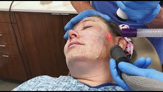 Full Face Fractional CO2 Laser Resurfacing for Wrinkles and Skin Tightening [upl. by Nylrebmik512]