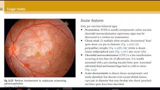 Kanski Clinical Ophthalmology Made Easy  Uveitis 5 [upl. by Adniled343]