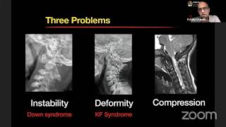 Atlantoaxial Dislocation in Downs Syndrome [upl. by Rayham]