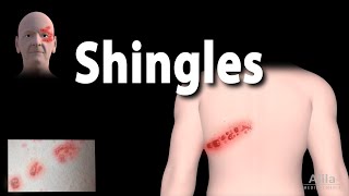 Shingles Pathophysiology Symptoms 3 stages of Infection Complications Management Animation [upl. by Kronfeld]