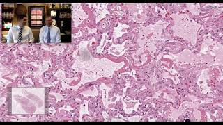 Pattern 1  Acute Lung Injury [upl. by Esimehc]