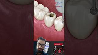 Dental Restoration ↪ Composite Bonding Teeth ↪ 3D Medical Animation [upl. by Norrehc219]