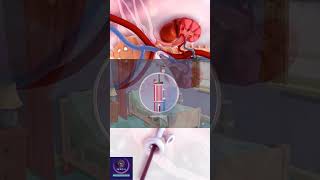 Artificial kidney or Dialysis education shorts [upl. by Leaffar]