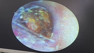 Cerumen embolism cleaning earwax Cleaning earwaxremoval satisfying [upl. by Keir]