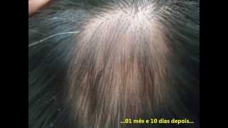 ALOPECIA AREATA TEM CURA Alopecia areata can be cured [upl. by Durkee966]