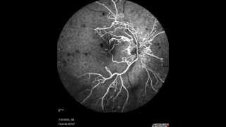 Central Retinal Vein Occlusion [upl. by Ali]