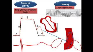 ECG course Torsades de Pointes Dr Sherif Altoukhy [upl. by Ydnab]