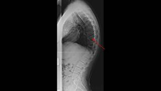 Scheuermanns Disease [upl. by Astra]