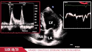 Acute Myocardial Infarction [upl. by Junko704]