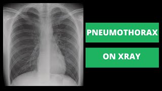 How to Identify a Pneumothorax on Xray  Strategies from a Radiologist [upl. by Vanny639]