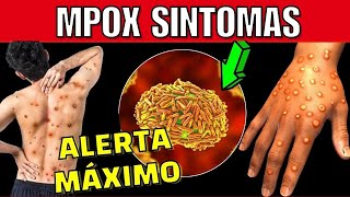 MPOX SINTOMAS COMO RECONHECER AS LESÃ•ES DE PELE e COMO SE PROTEGER MPOX [upl. by Yortal469]