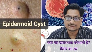 Epidermoid Cyst  Epidermal Cyst  क्या यह ख़तरनाक परेशानी है कैंसर का कितना chance है Skin Cyst [upl. by Yemorej]