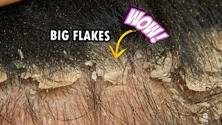 Picking Big Scalp Flakes Psoriasis Dandruff Scratching Satisfying 301 [upl. by Naellij]