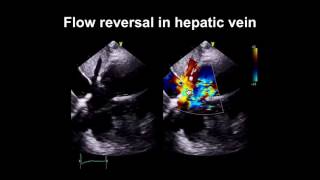 Echocardiography Essentials Spotting tricuspid and pulmonary valve disease [upl. by Hibbs]