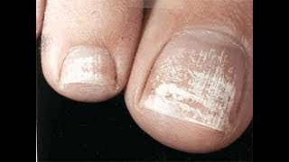 Dry Painful Toenail or Fingernails Home Treatment and Home Cure [upl. by Yessak33]