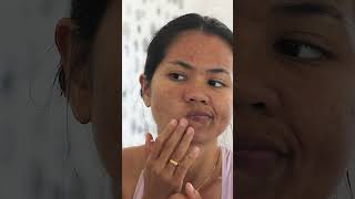 How to get rid of Acne  Best Acne Treatment  Siya Ayurveda Anti Acne Kit shorts acne pimple [upl. by Dalis5]