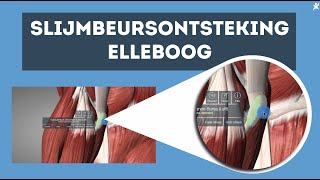 Slijmbeursontsteking elleboog Ontdek de oplossing [upl. by Aeniah]