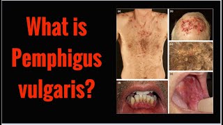 What is PEMPHIGUS VULGARIS Symptoms Causes [upl. by Dayle]