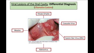 12DaysinMarch Oral Health Series Part 2a Oral Lesions Viral Bacterial for Step One [upl. by Anid551]