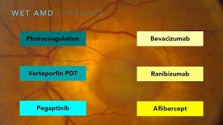 Wet AgeRelated Macular Degeneration Wet AMD [upl. by Orelee]