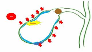 Colecistitis aguda fisiopatologia [upl. by Kippie]