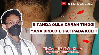 8 Tanda Kulit Kamu Mengalami Gula Darah Tinggi  DIABETES dokyudra [upl. by Becky148]