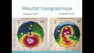 Photokératectomie thérapeutique PKT topoguidée sur le kératocône [upl. by Ococ]