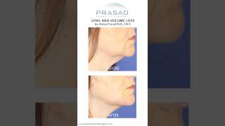 How Treatment for Jowls can be Done with Filler jowls [upl. by Anahc]