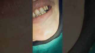 Dental treatment cosmeticdentistry scalingdentalcare  viral videos [upl. by Nesyt714]