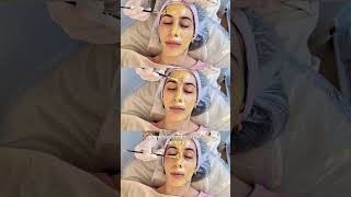 Yellow Peel Peeling YellowPeel Acne acnetreatment [upl. by Notsa]