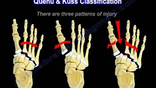 Lisfranc Injuries  Everything You Need To Know  Dr Nabil Ebraheim [upl. by Ley]