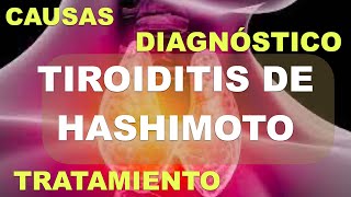 Tiroiditis de Hashimoto Fisiopatología Diagnóstico y Tratamiento [upl. by Valene]