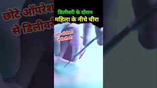 Normal delivery में छोटा ऑपरेशन chotaoperation episiotomy [upl. by Eustis]