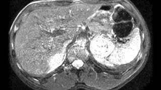 Pheochromocytoma [upl. by Lipcombe]