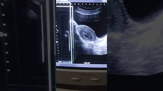 Gestational sac of 4 weeks with transabdominal ultrasound by medical radiology [upl. by Johppah]