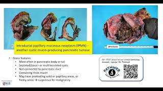 Pancreas Mucinous cystic neoplasm Gross pathology [upl. by Miquela87]