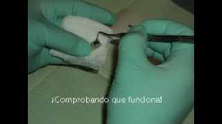 Papacarie Remocion Quimico Mecania de Caries  Mesa Clinica [upl. by Adraynek]