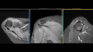 Calcific tendinitis of shoulder [upl. by Adamo]