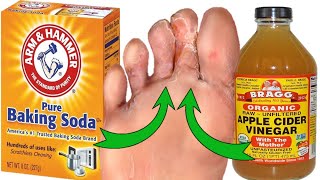 Say Goodbye to Athletes Foot Naturally Baking Soda amp Apple Cider Vinegar [upl. by Rourke192]